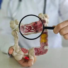 How Colorectal Cancer Surgery Can Improve Your Quality of Life