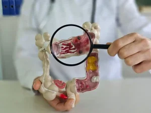 Colorectal Cancer Surgery: A New Hope for Better Life