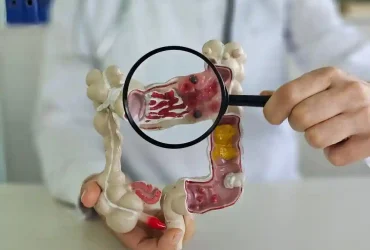 Colorectal Cancer Surgery: A New Hope for Better Life