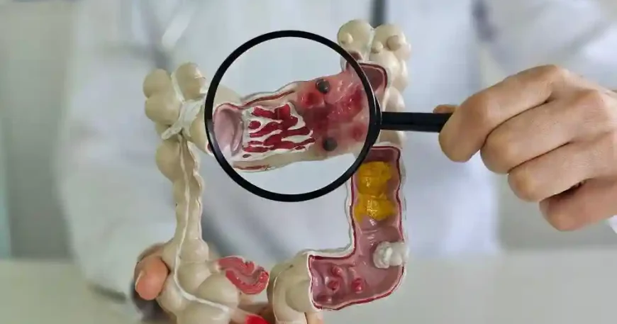 Colorectal Cancer Surgery: A New Hope for Better Life