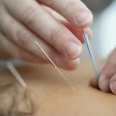 The Benefits of Acupuncture Therapy for Pain Relief