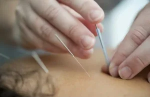 The Benefits of Acupuncture Therapy for Pain Relief