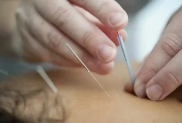 The Benefits of Acupuncture Therapy for Pain Relief