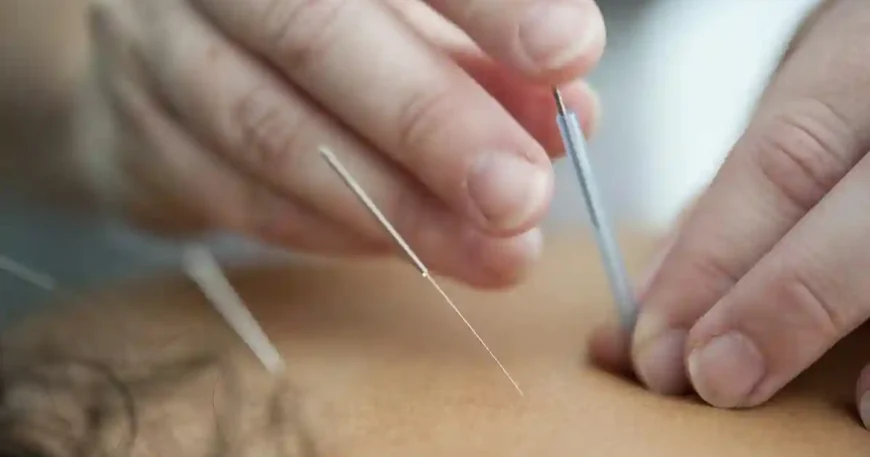 The Benefits of Acupuncture Therapy for Pain Relief